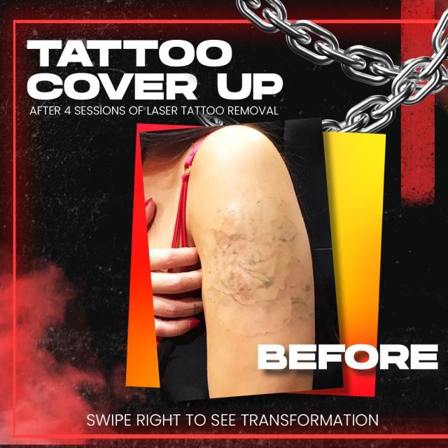 Tattoo Removal Ribs Before and After | TikTok